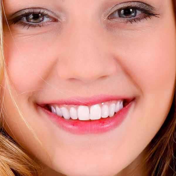 La misma sonrisa después del tratamiento estético