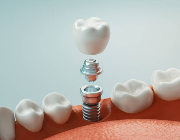 implantes dentales con tornillos