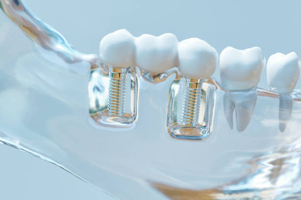 implantes de titanio