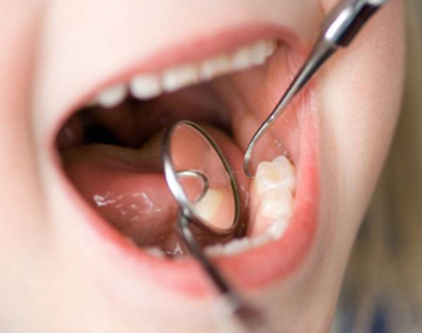La Importancia de los Selladores Dentales para NiÃ±os